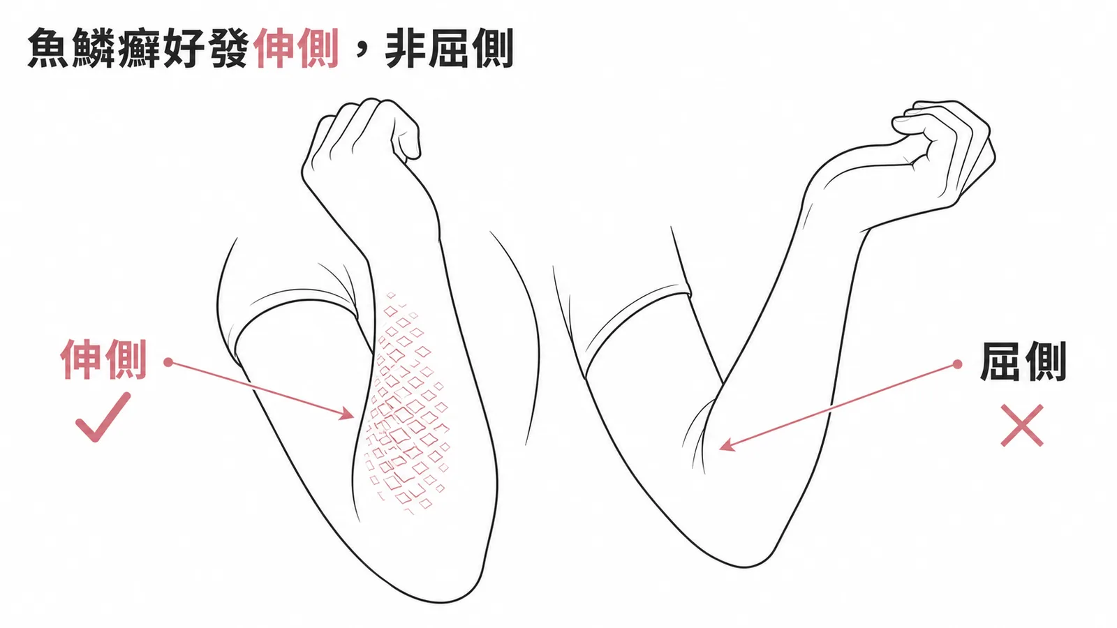 尋常性魚鱗癬鱗屑好發四肢伸側，非屈側