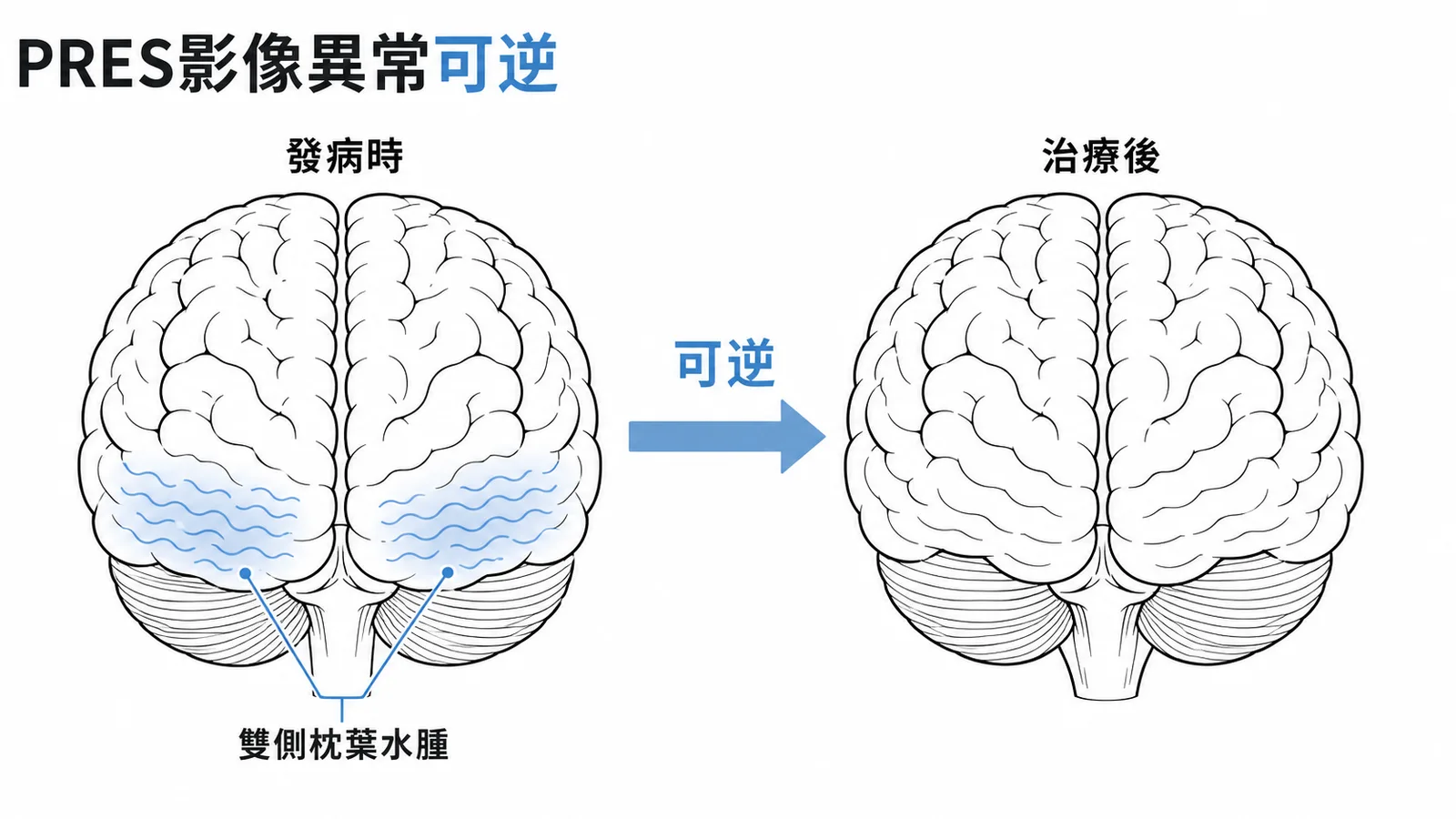 PRES的MRI枕葉水腫在治療後可逆消退