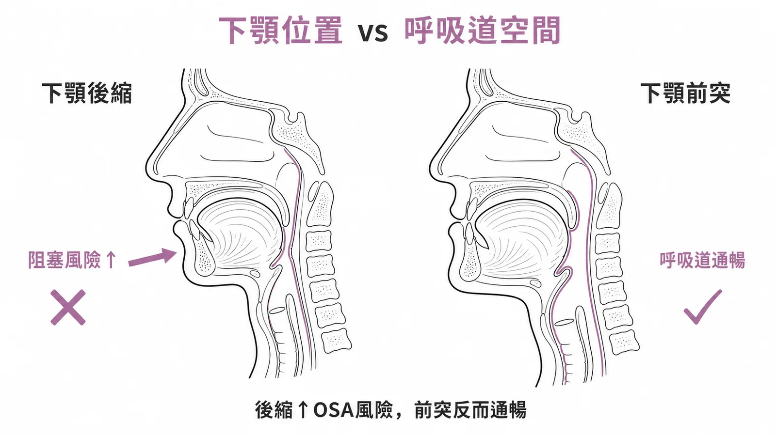 下顎後縮使呼吸道狹窄增加OSA風險而下顎前突反而通暢