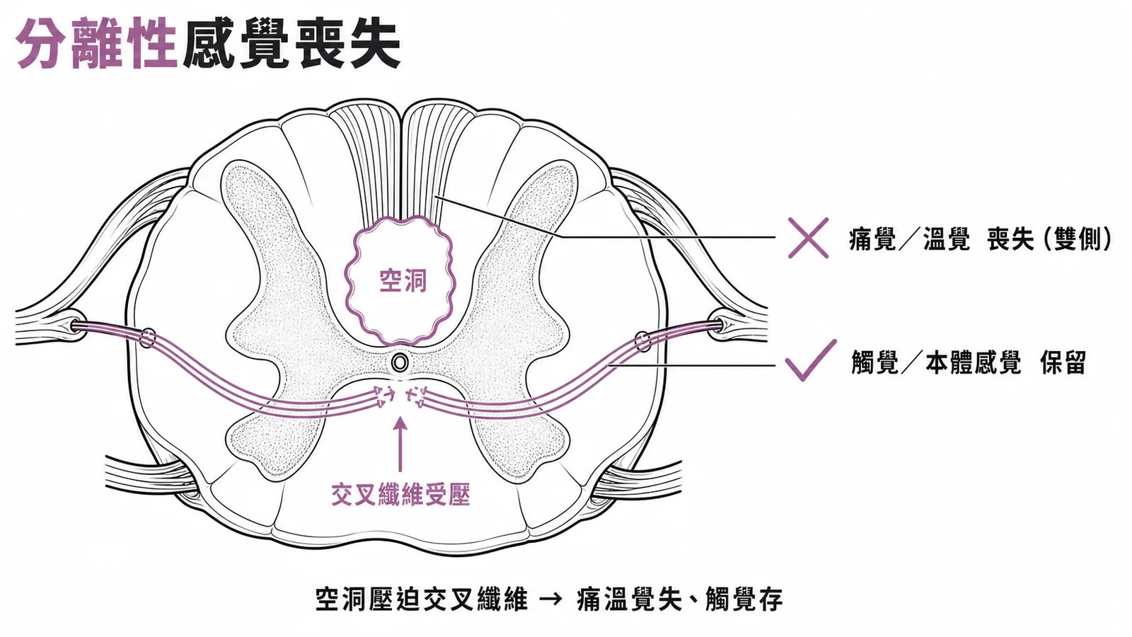 脊髓空洞症分離性感覺喪失:空洞壓迫交叉纖維導致痛溫覺失觸覺存