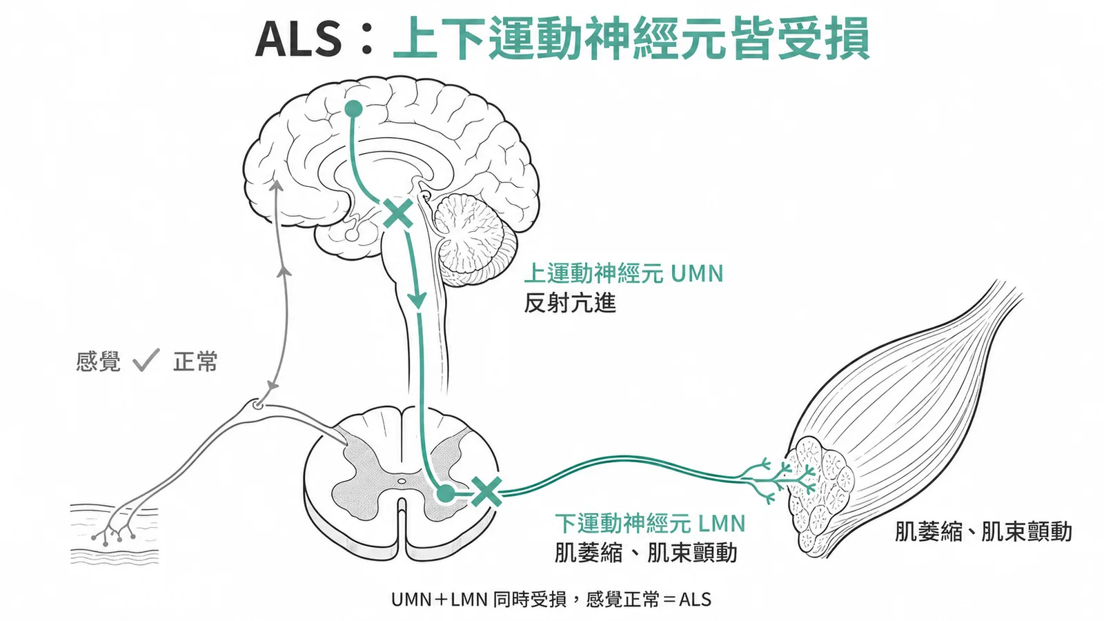 ALS上下運動神經元同時受損但感覺正常的診斷特徵