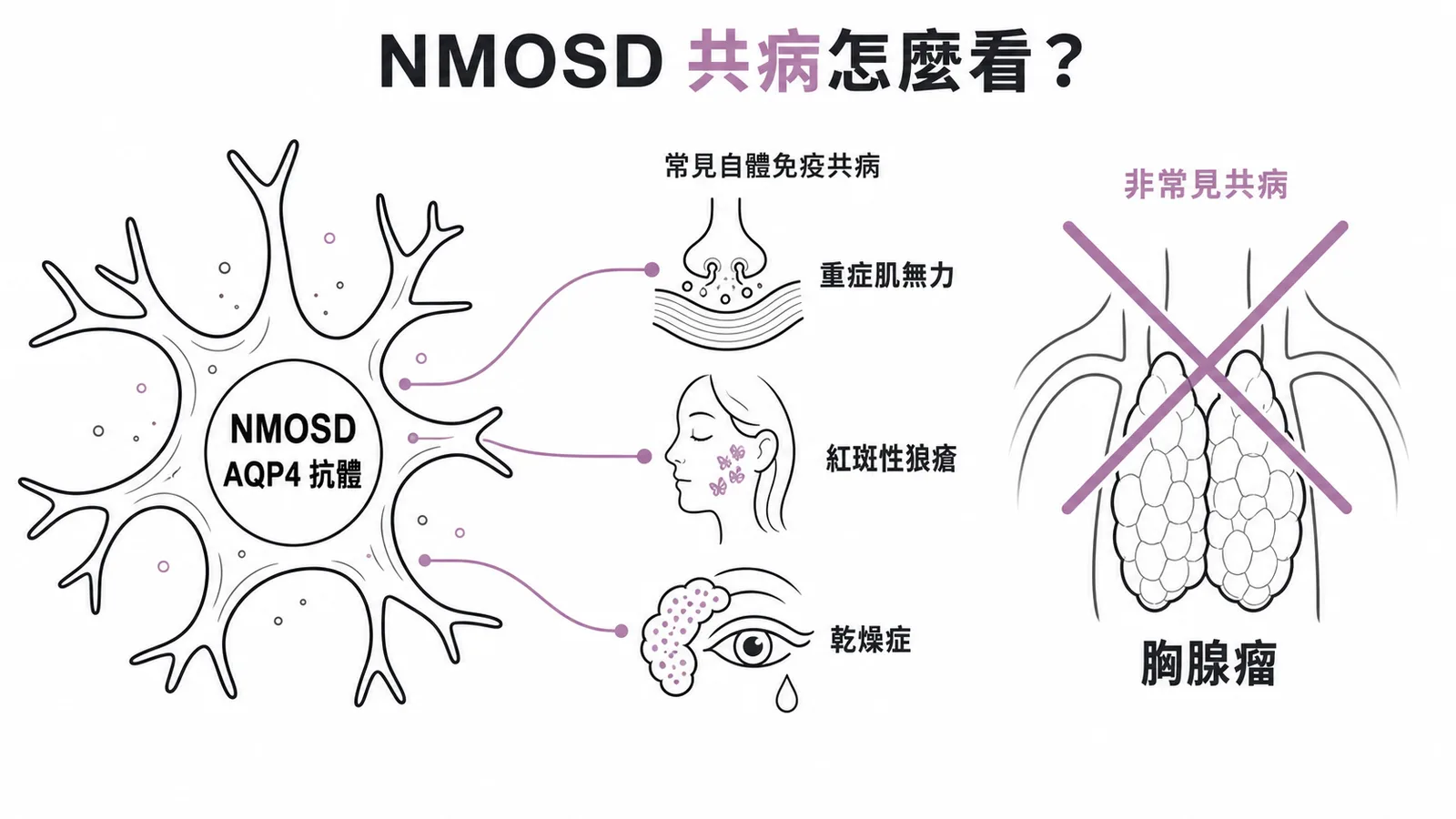 NMOSD常見共病為自體免疫疾病,胸腺瘤非其常見共病