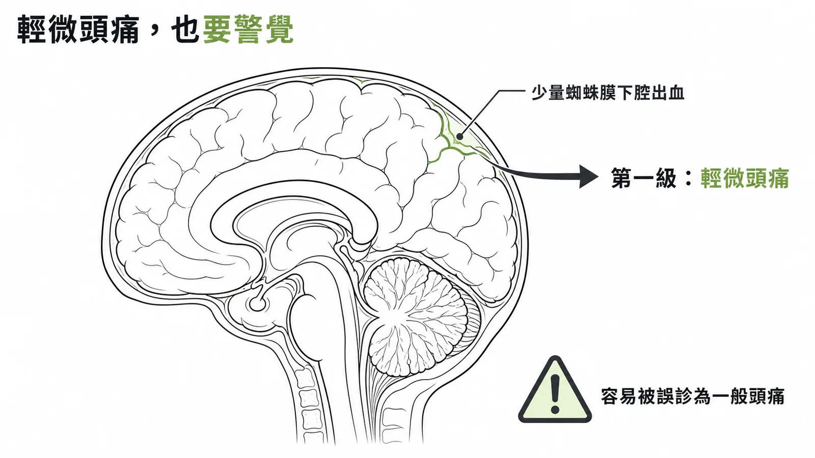 蜘蛛膜下腔出血Grade 1輕微頭痛容易被誤診