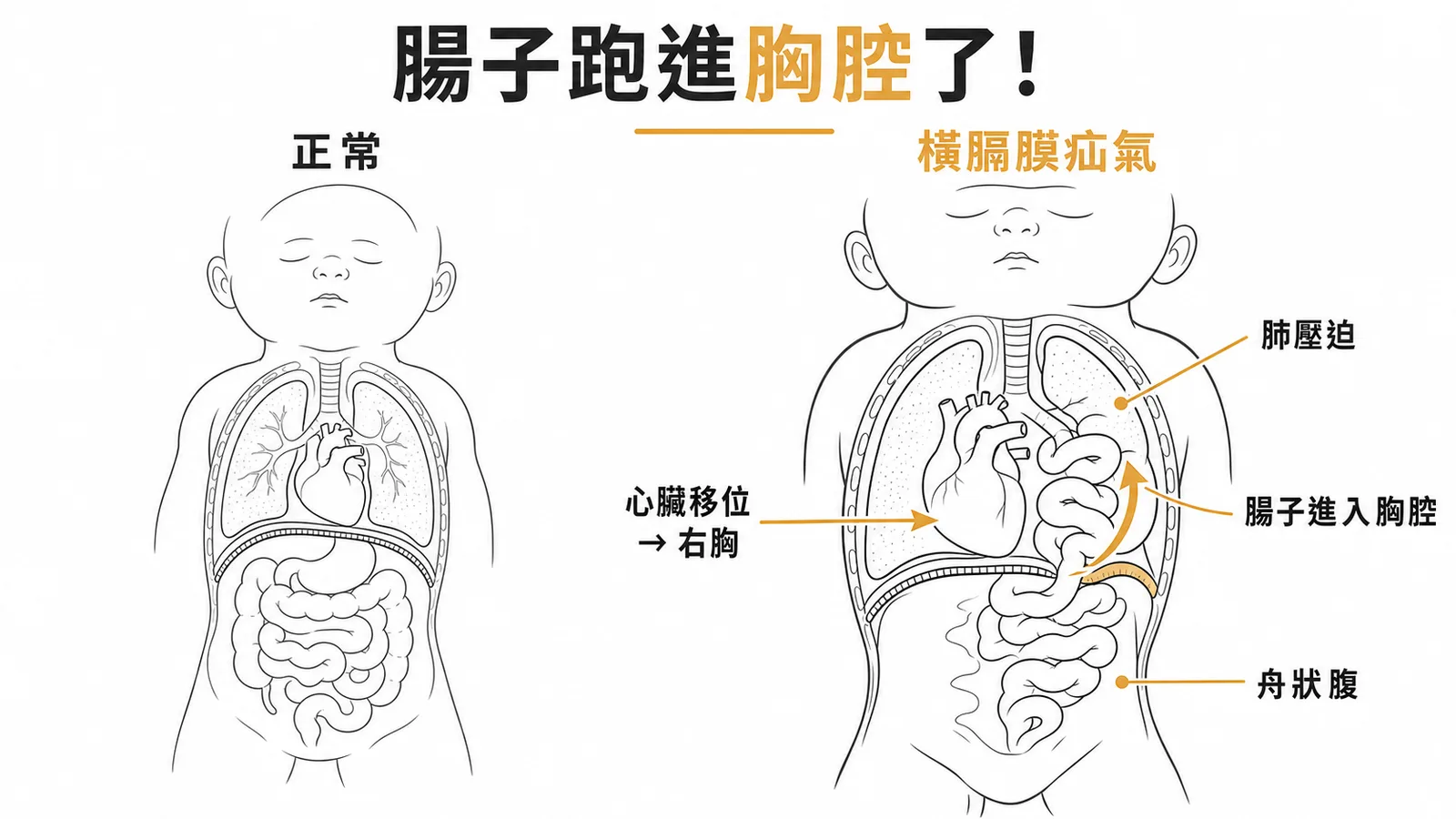 先天性橫膈膜疝氣：腹部臟器經缺損進入胸腔造成肺壓迫與心臟移位