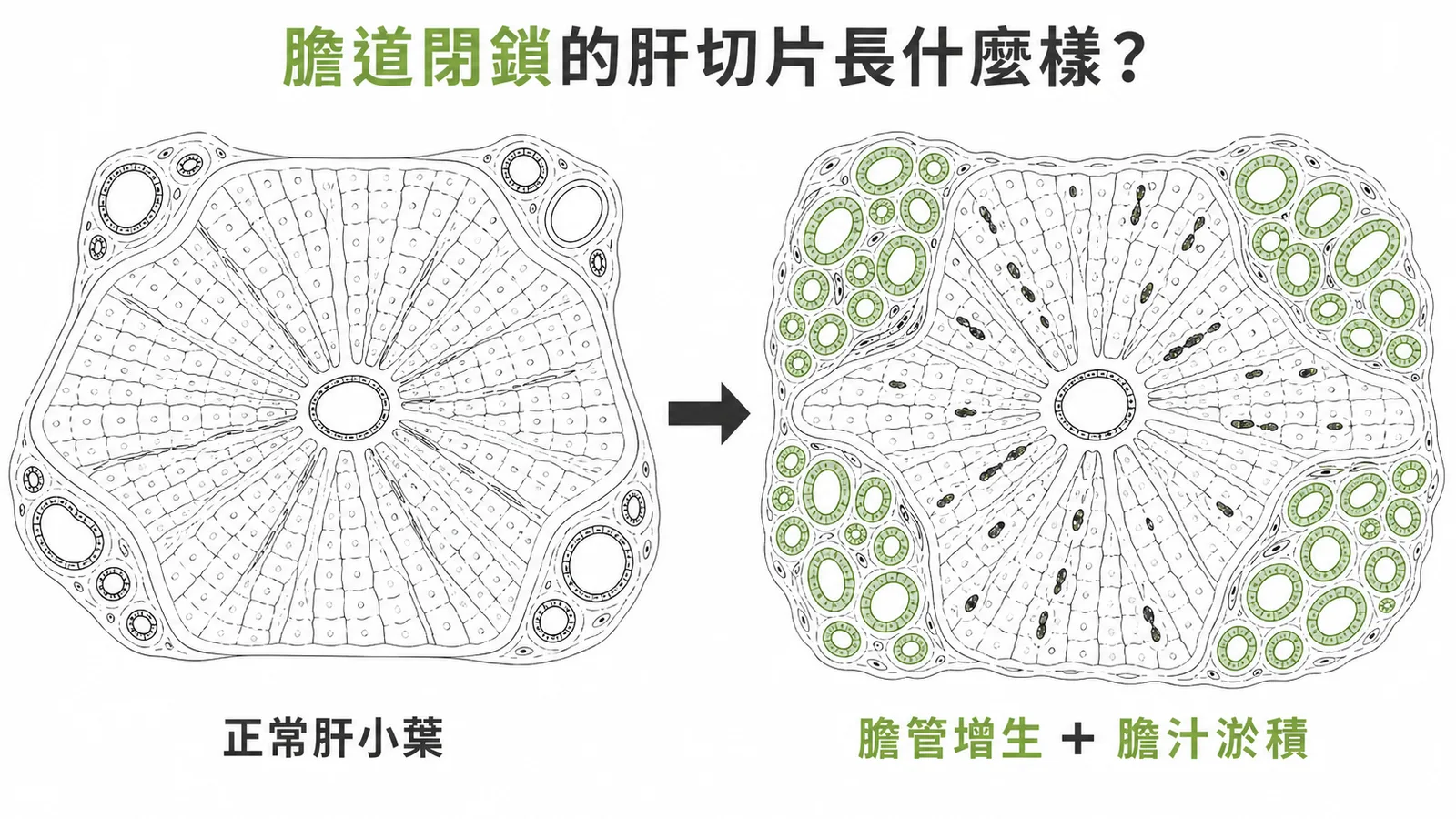 膽道閉鎖肝切片：正常肝小葉 vs 膽管增生加膽汁淤積的對比示意圖