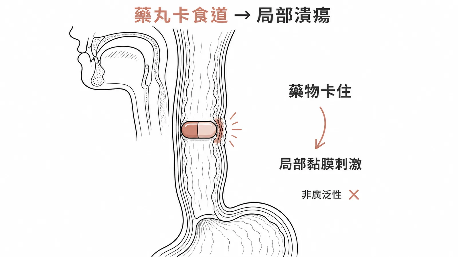 藥物性食道炎：藥丸卡在食道中段造成局部潰瘍的示意圖