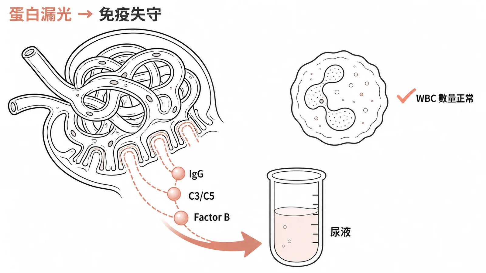 腎病症候群蛋白流失導致免疫功能下降的示意圖