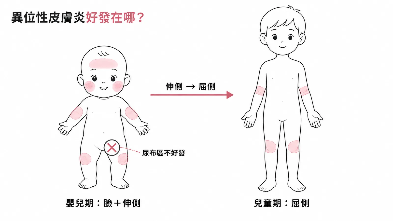 異位性皮膚炎好發位置隨年齡改變:嬰兒期臉加伸側、兒童期屈側、尿布區不好發