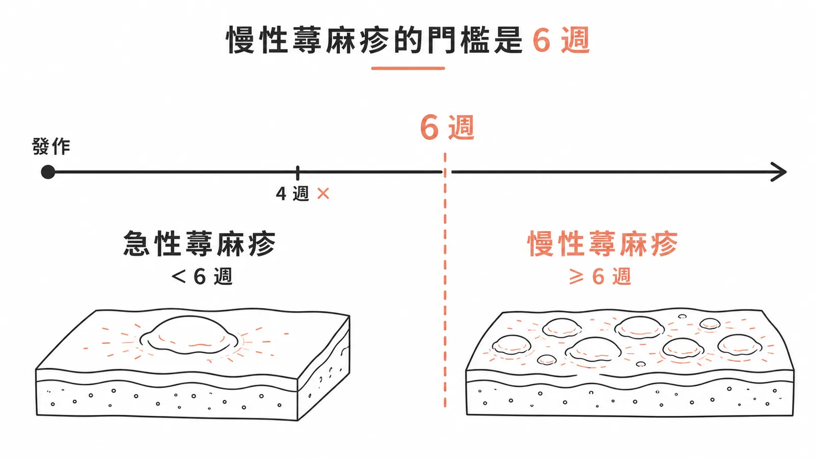 蕁麻疹急性與慢性的分界：六週時間軸示意圖