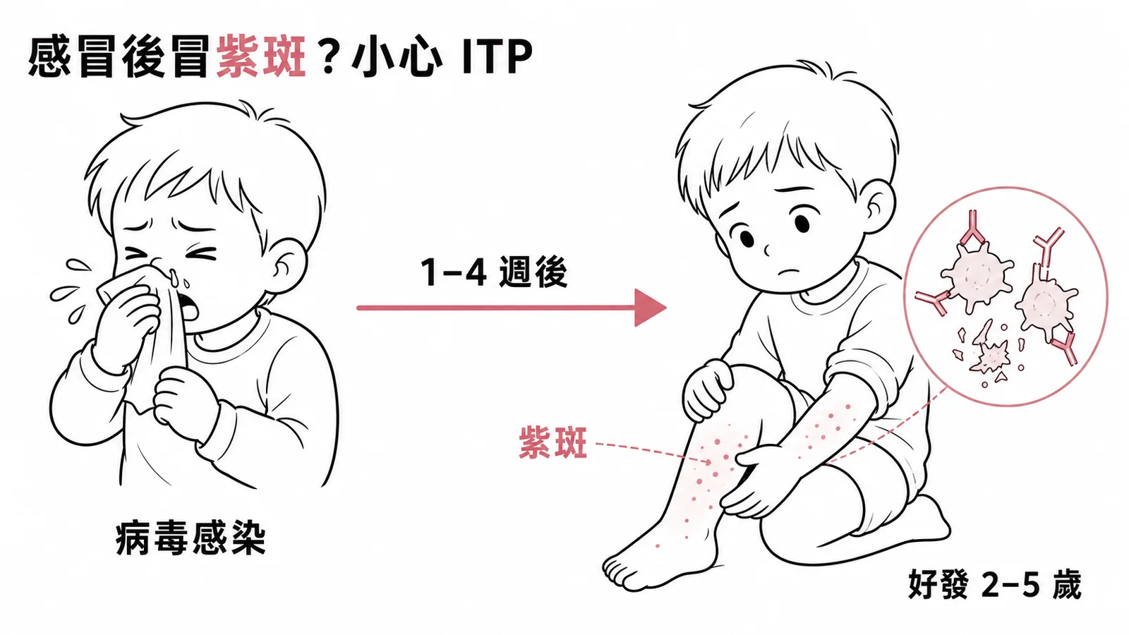 兒童ITP發病時序：病毒感染後一到四週出現紫斑的示意圖