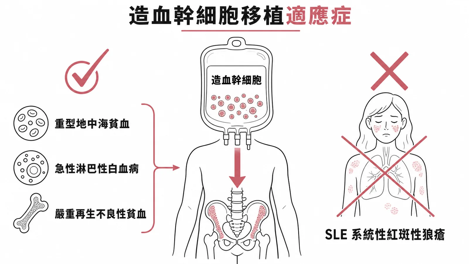 造血幹細胞移植適應症：地中海貧血、ALL、再生不良性貧血適用，SLE非適應症