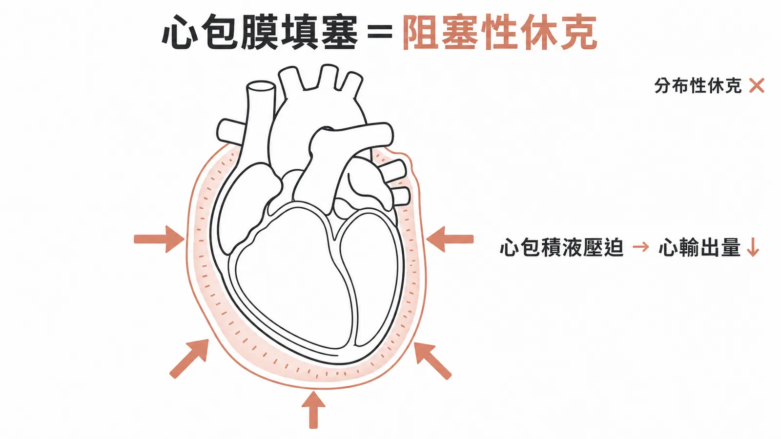 心包膜填塞屬於阻塞性休克，心包積液壓迫心臟致心輸出量下降