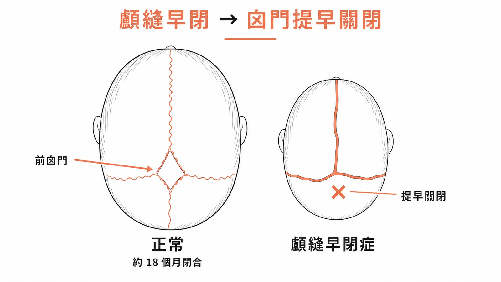 顱縫早閉導致前囟門提早關閉的頭頂對比圖