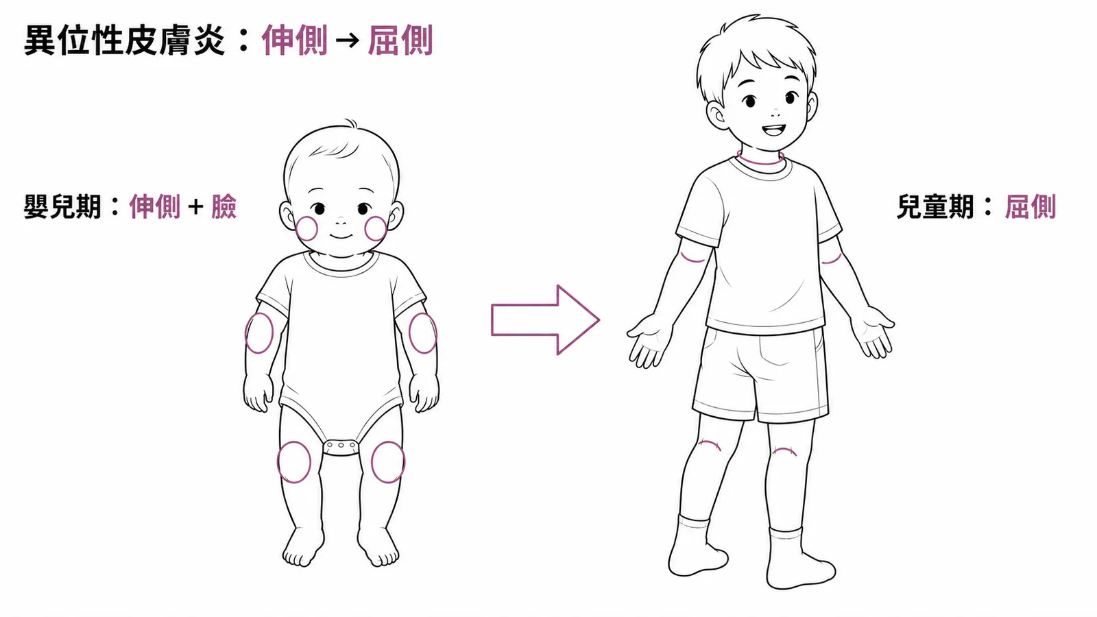 異位性皮膚炎好發位置隨年齡改變:嬰兒伸側→兒童屈側