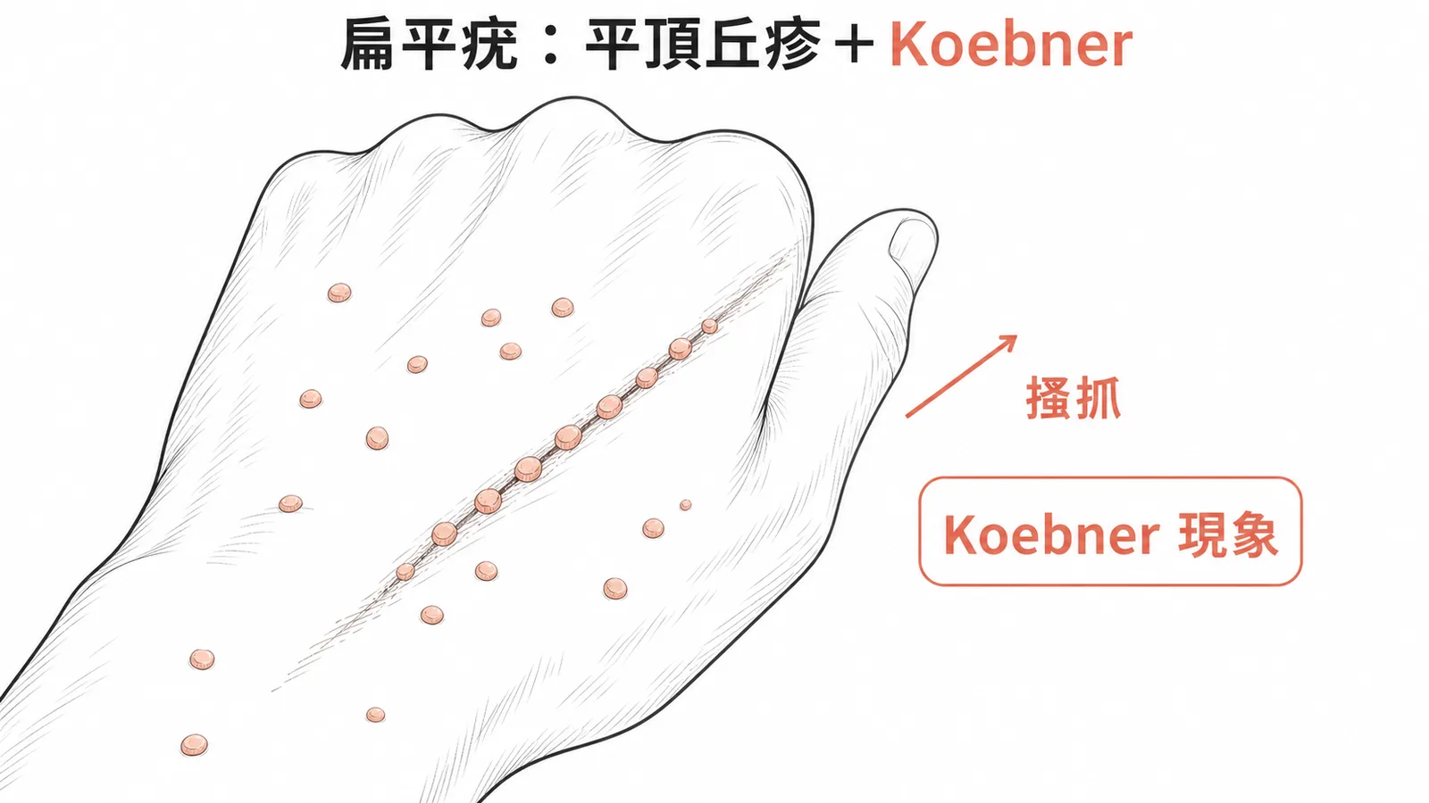 扁平疣特徵:手背平頂丘疹沿搔抓線排列的Koebner現象
