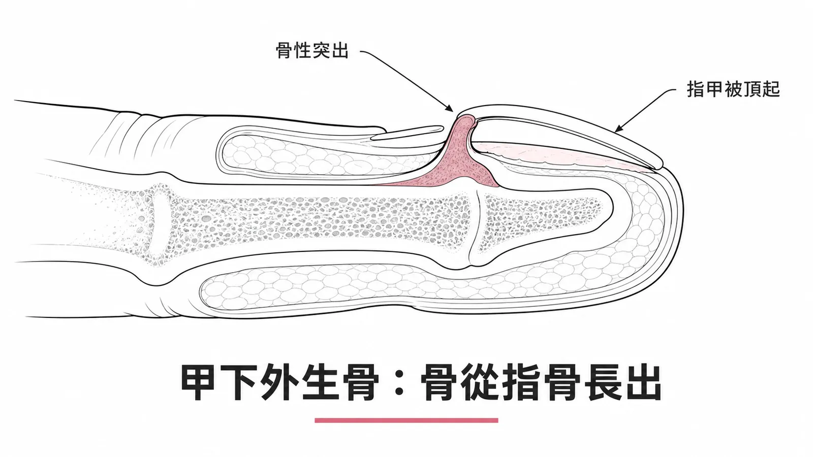 甲下外生骨：指骨骨性突出頂起指甲的剖面示意圖