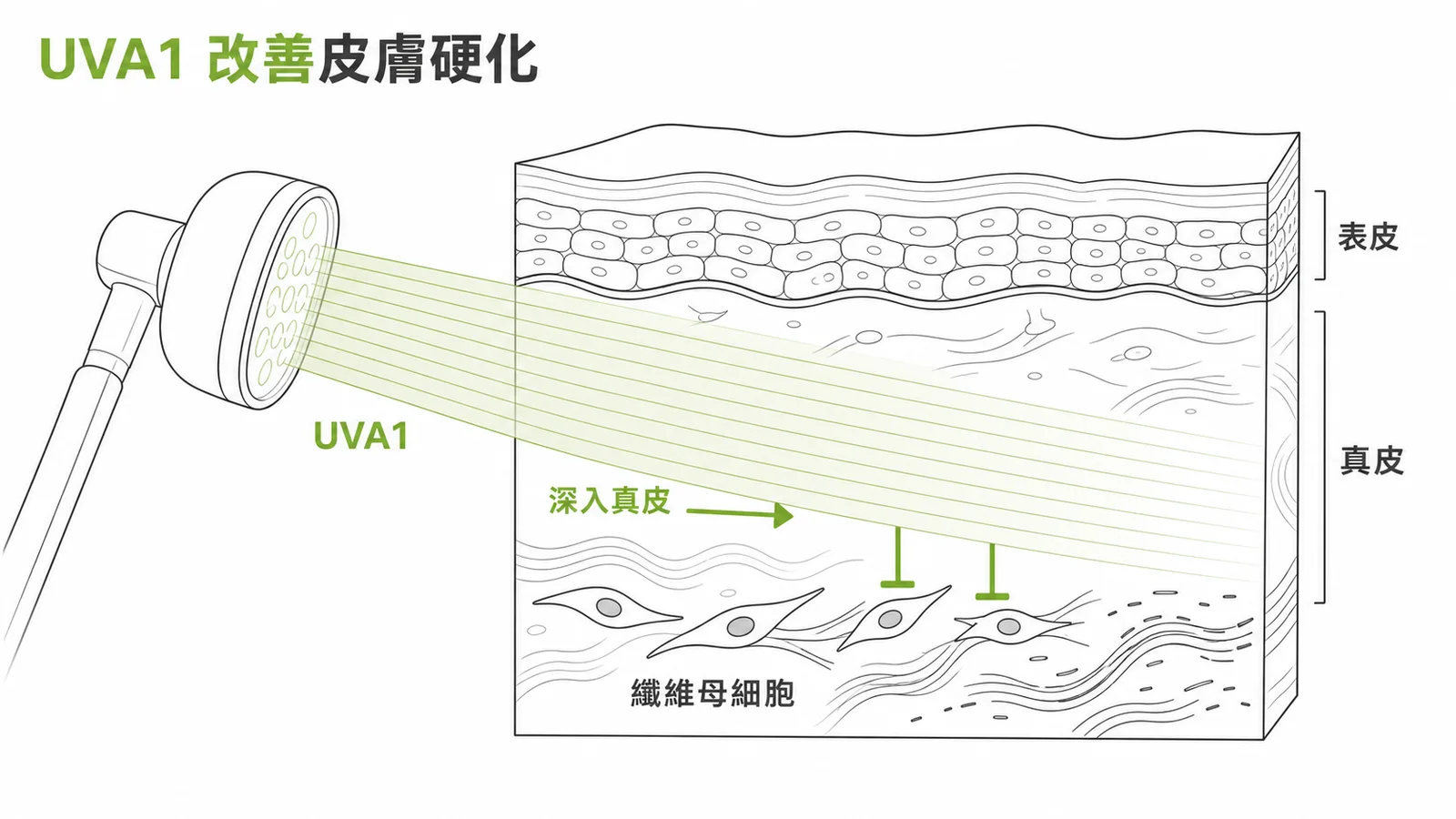 UVA1 紫外光深入真皮層改善全身性硬化症皮膚硬化