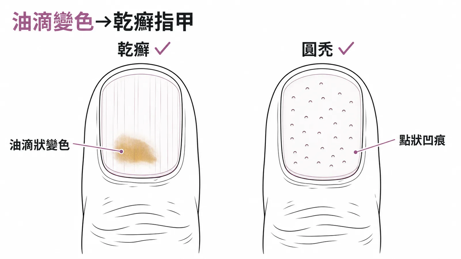 油滴狀變色是乾癬指甲的典型表現,圓禿則以點狀凹痕為主