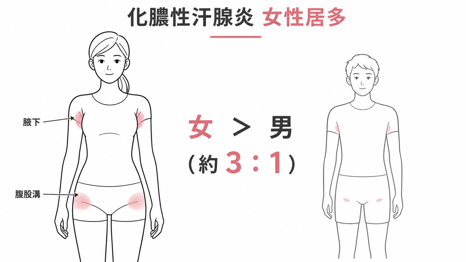 化膿性汗腺炎女性比男性常見，好發腋下與腹股溝