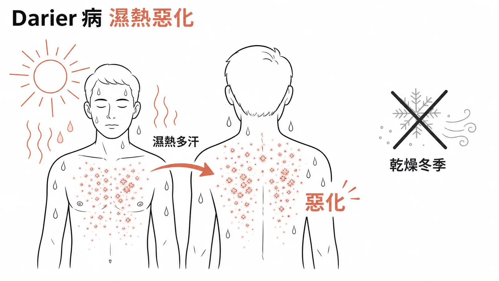 Darier 病在潮濕炎熱多汗環境下惡化，非乾燥冬季