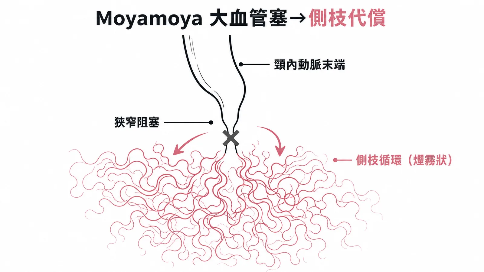 Moyamoya 病頸內動脈狹窄阻塞後代償性側枝循環呈煙霧狀
