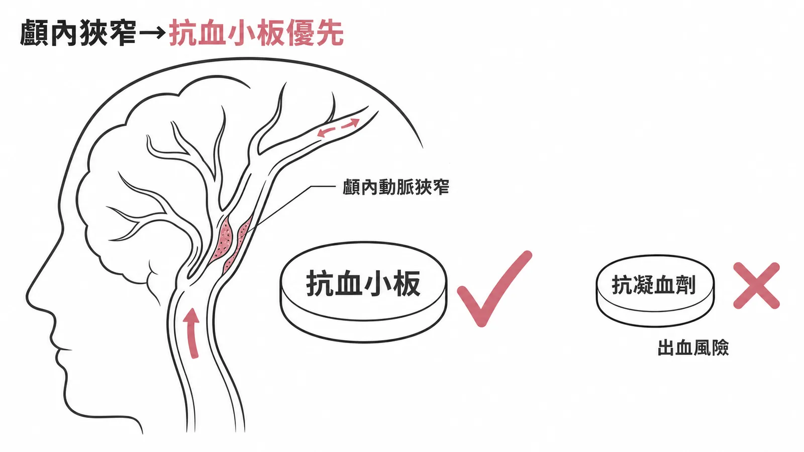 症狀性顱內動脈狹窄應優先用抗血小板藥物而非抗凝血劑