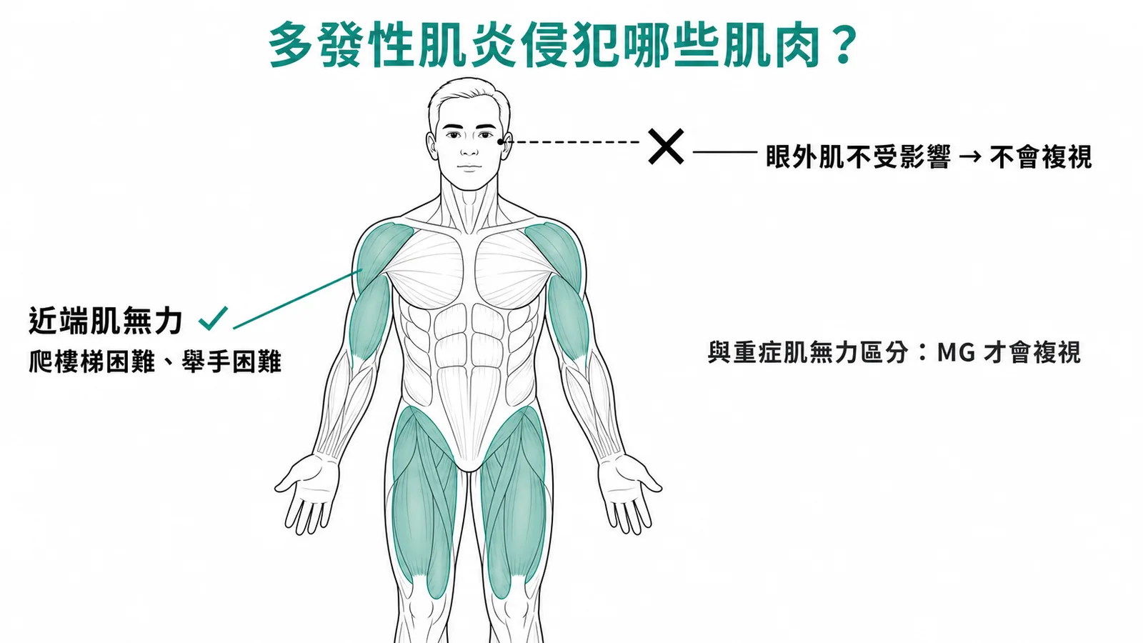 多發性肌炎侵犯近端肌肉，眼外肌不受影響不會複視