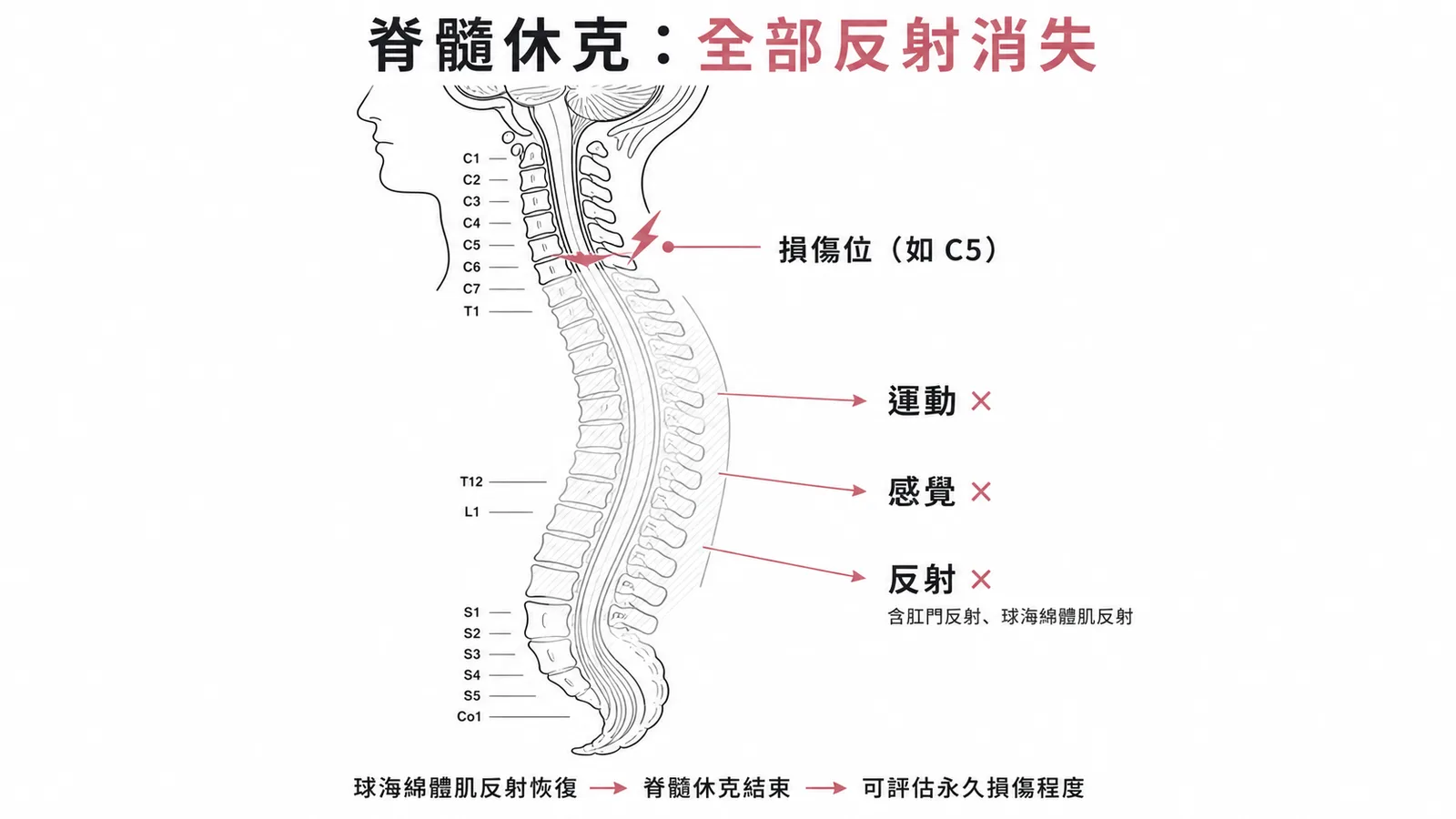 脊髓休克：損傷以下運動、感覺、反射全部消失，球海綿體肌反射恢復代表休克結束
