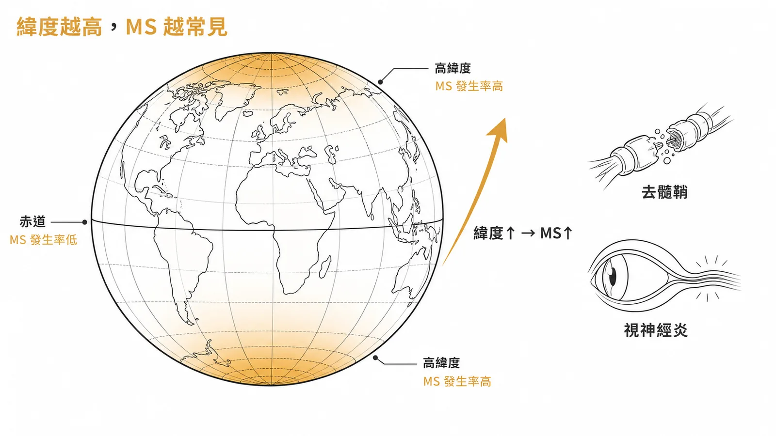 緯度越高 MS 越常見：去髓鞘病變與視神經炎