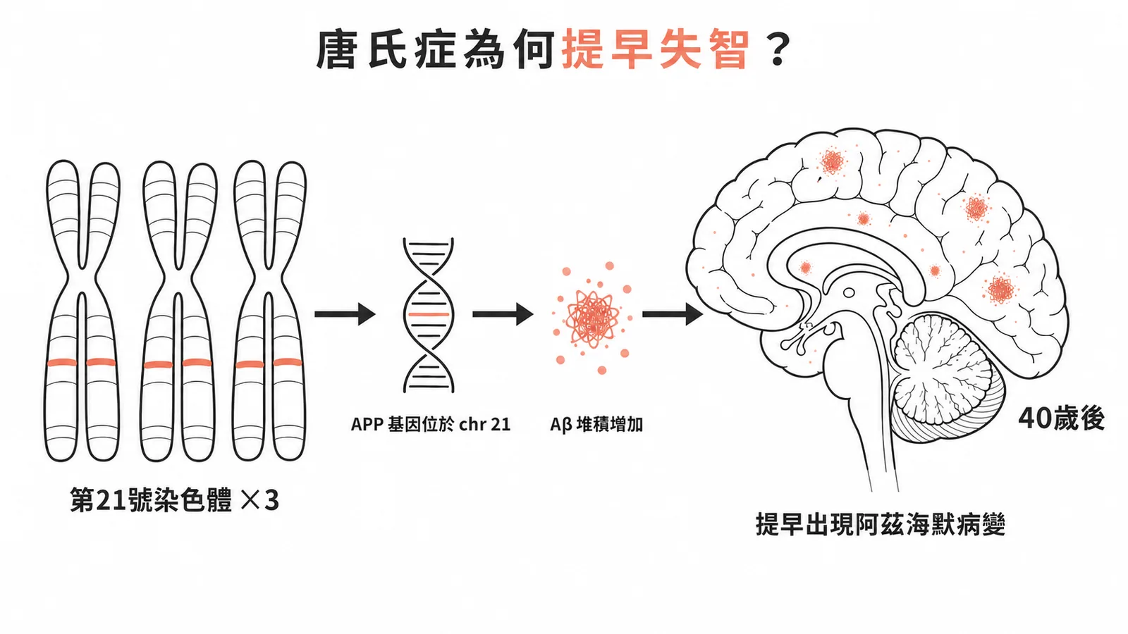 唐氏症三染色體21導致APP基因過度表現，Aβ堆積提早引發阿茲海默病變