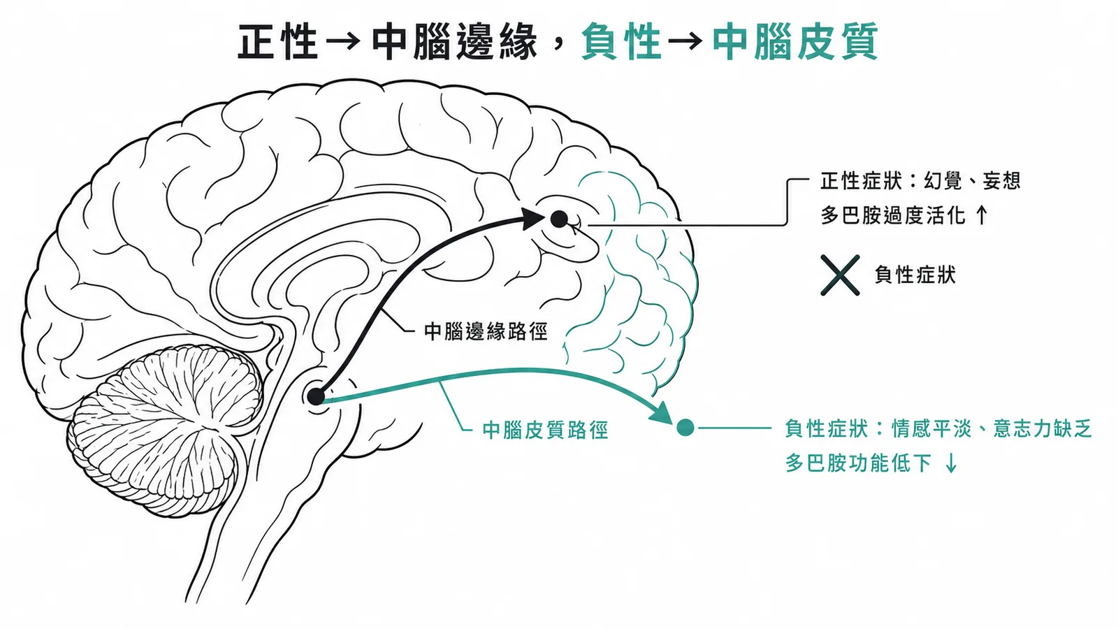 思覺失調症多巴胺路徑：正性症狀對應中腦邊緣、負性症狀對應中腦皮質