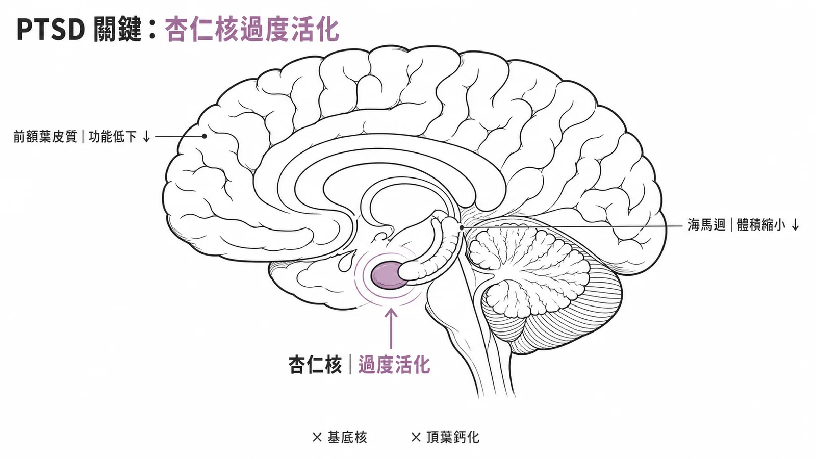 PTSD神經生物學：杏仁核過度活化、前額葉功能低下、海馬迴縮小