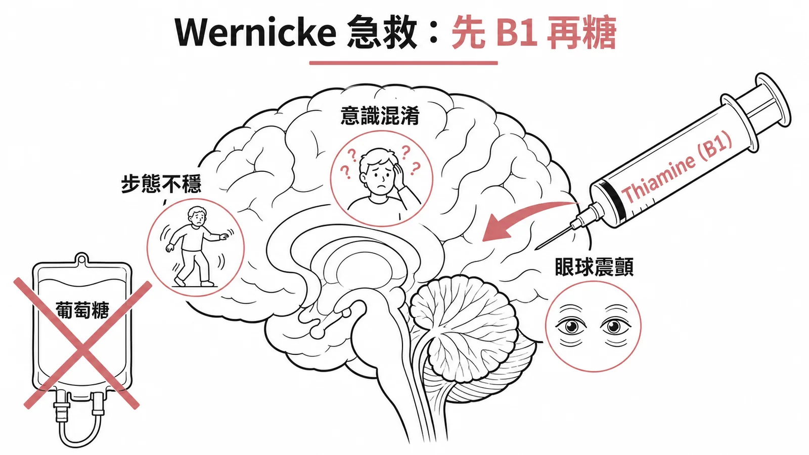 Wernicke腦病變急救處置:先補充Thiamine B1再給葡萄糖