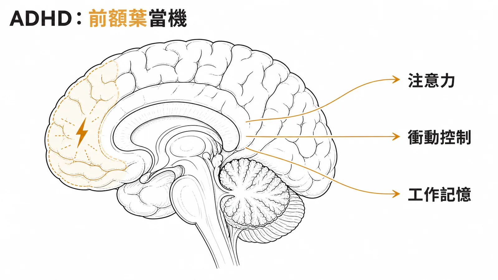 ADHD核心病因：前額葉皮質功能失調影響注意力、衝動控制與工作記憶