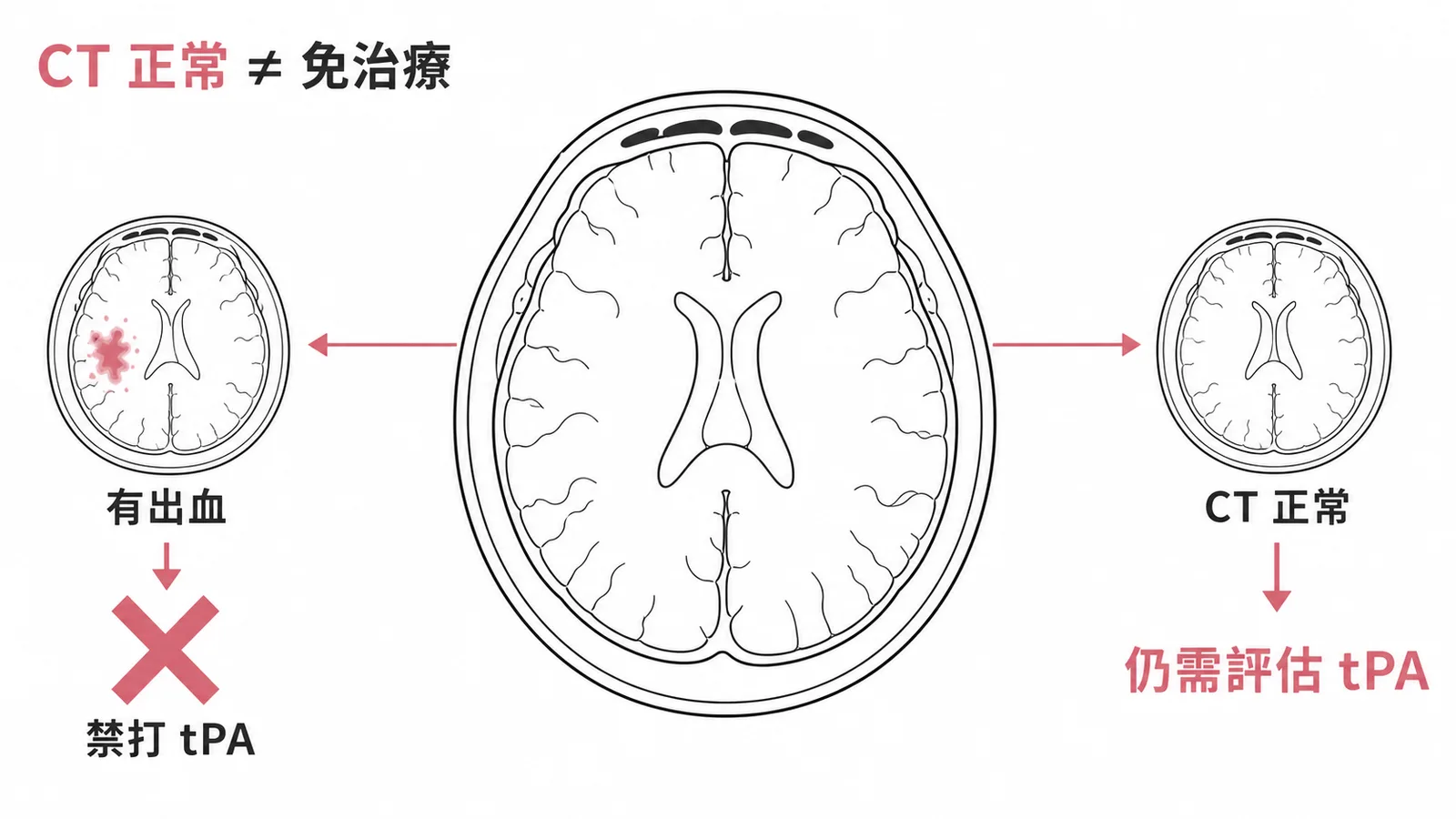 急性中風CT判讀：CT正常仍需評估tPA，有出血則禁打tPA