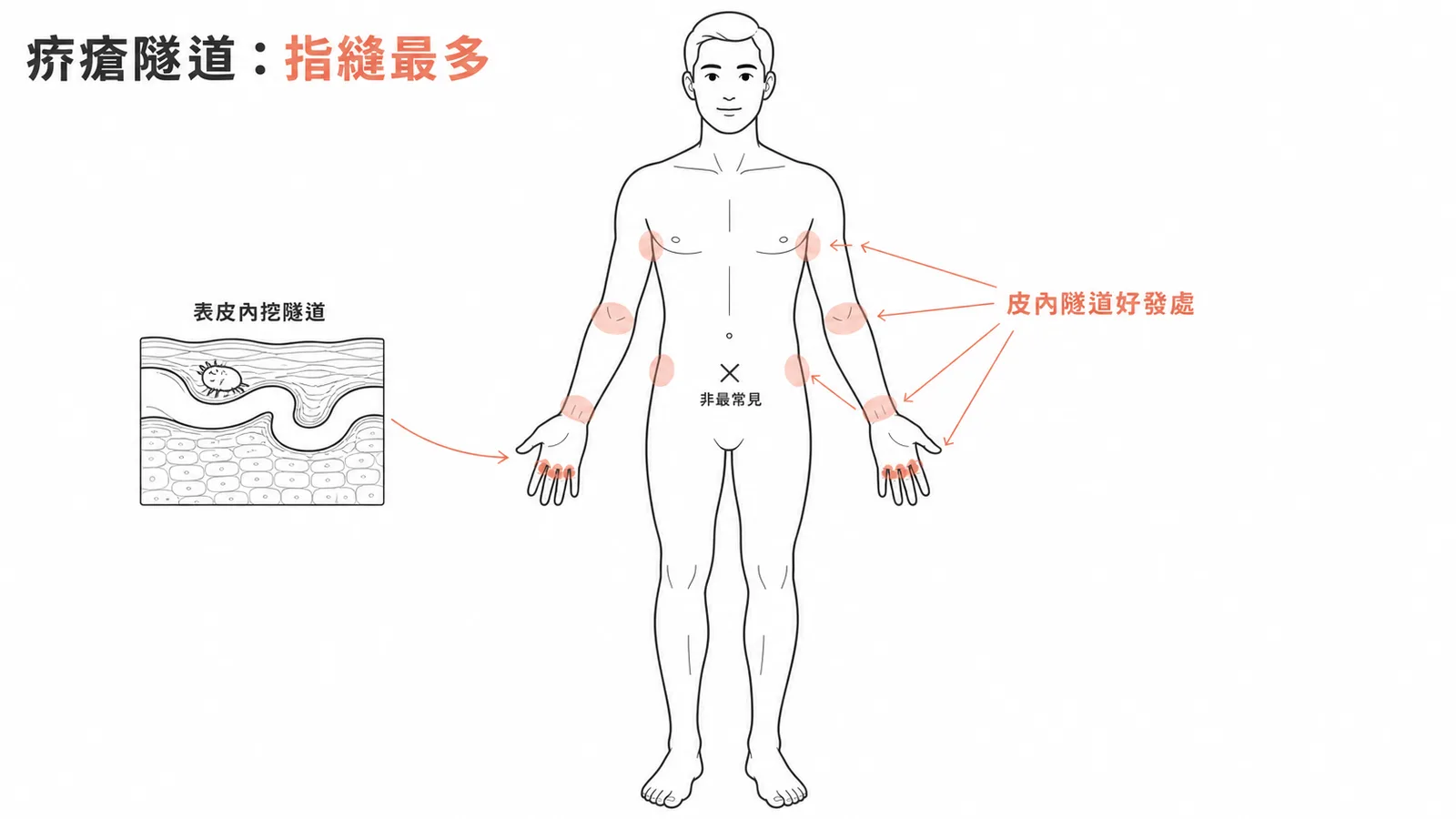 疥瘡皮內隧道好發位置:指縫、手腕、腋下最常見,肚子非最常見
