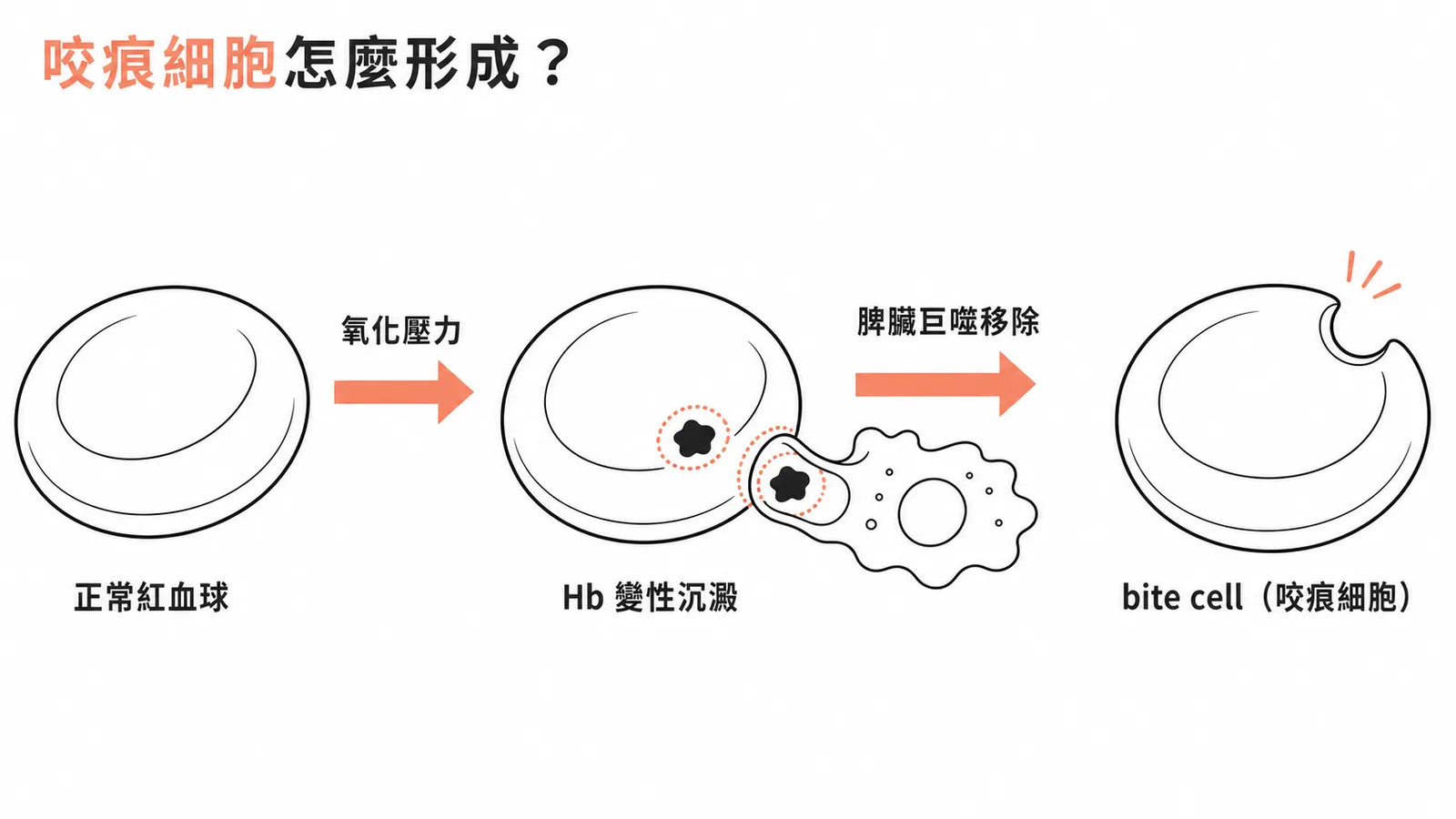 蠶豆症溶血形成咬痕細胞bite cell的機轉示意圖