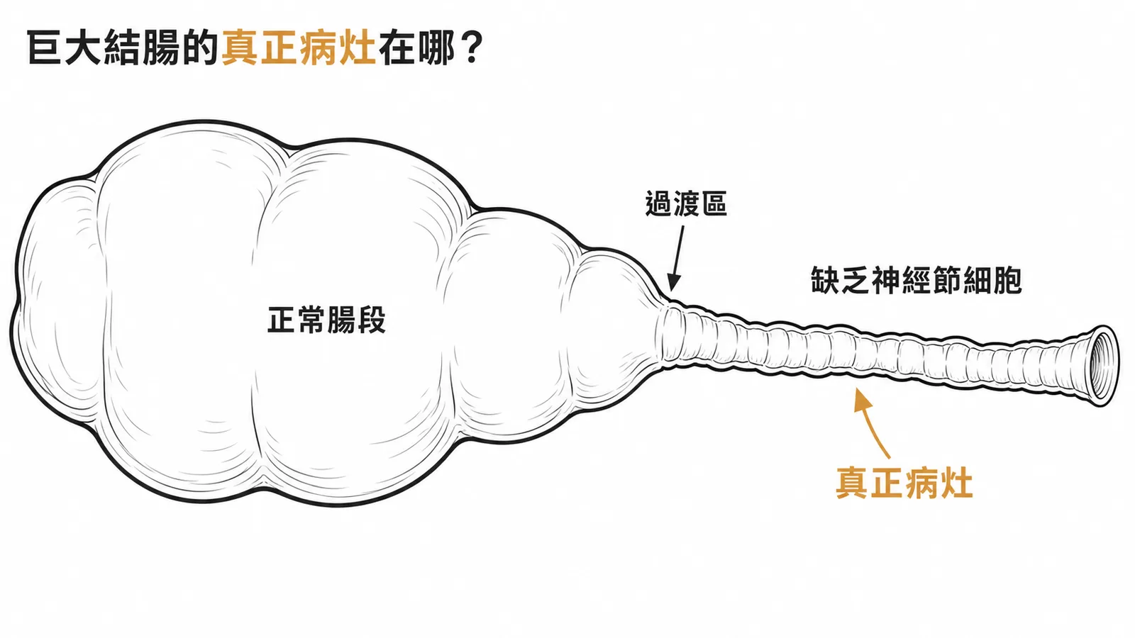 先天性巨大結腸症病灶在遠端狹窄段而非近端擴張段示意圖