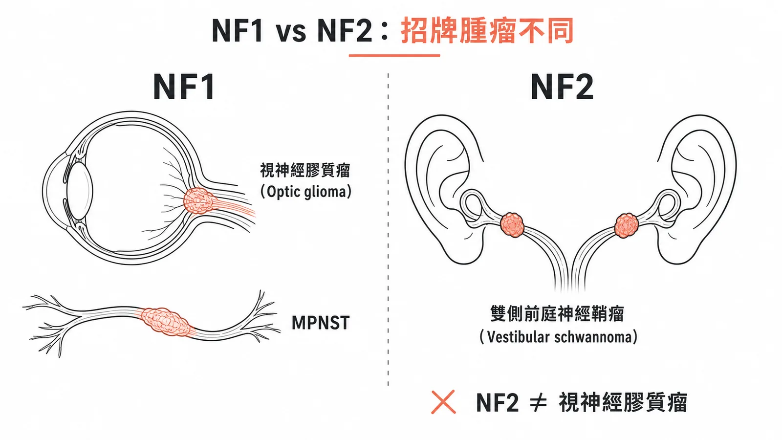 NF1 與 NF2 招牌腫瘤對照：視神經膠質瘤屬 NF1 而非 NF2