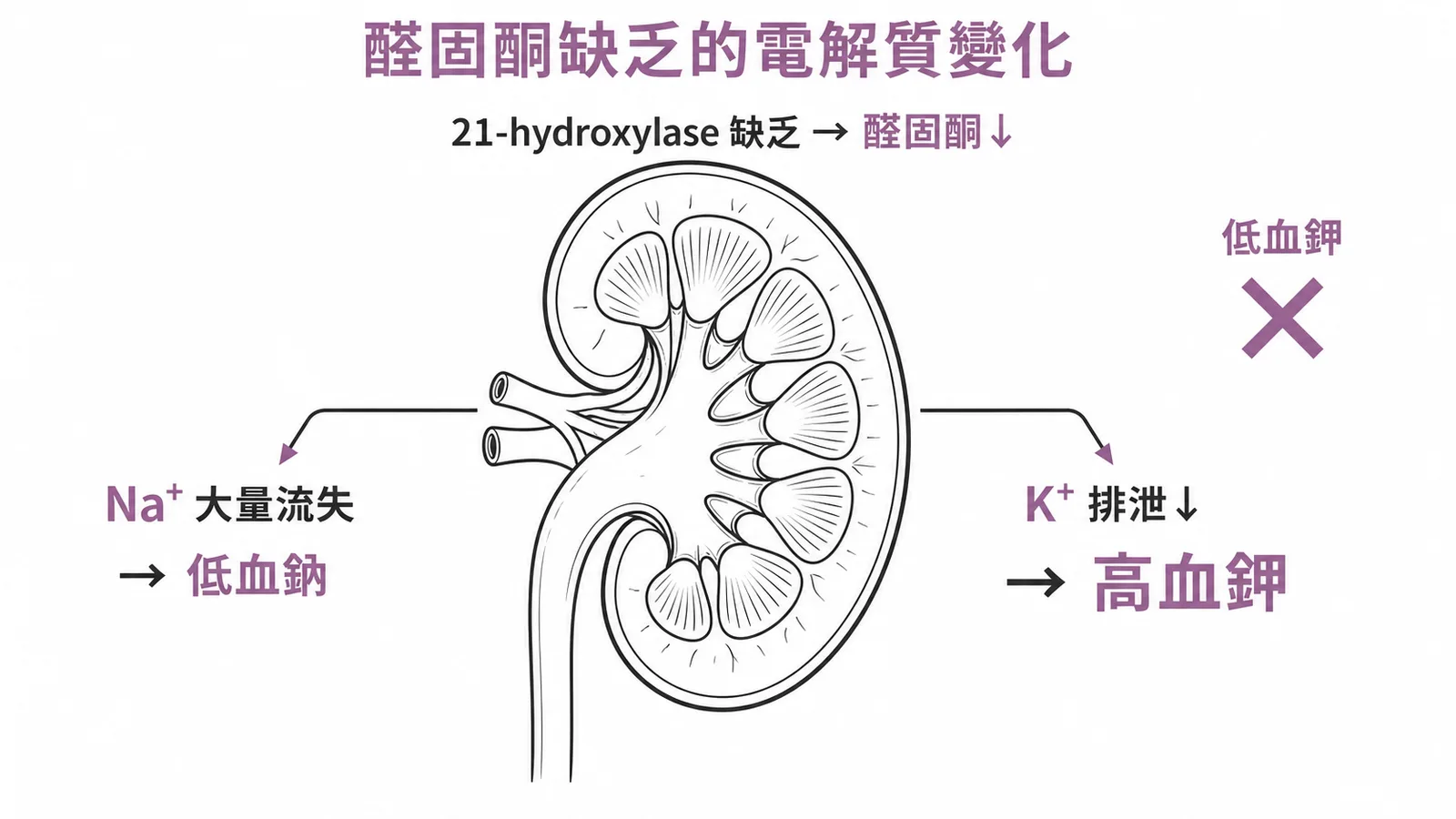 醛固酮缺乏的電解質變化：21-hydroxylase缺乏導致Na⁺流失低血鈉、K⁺排泄下降高血鉀，低血鉀是錯的