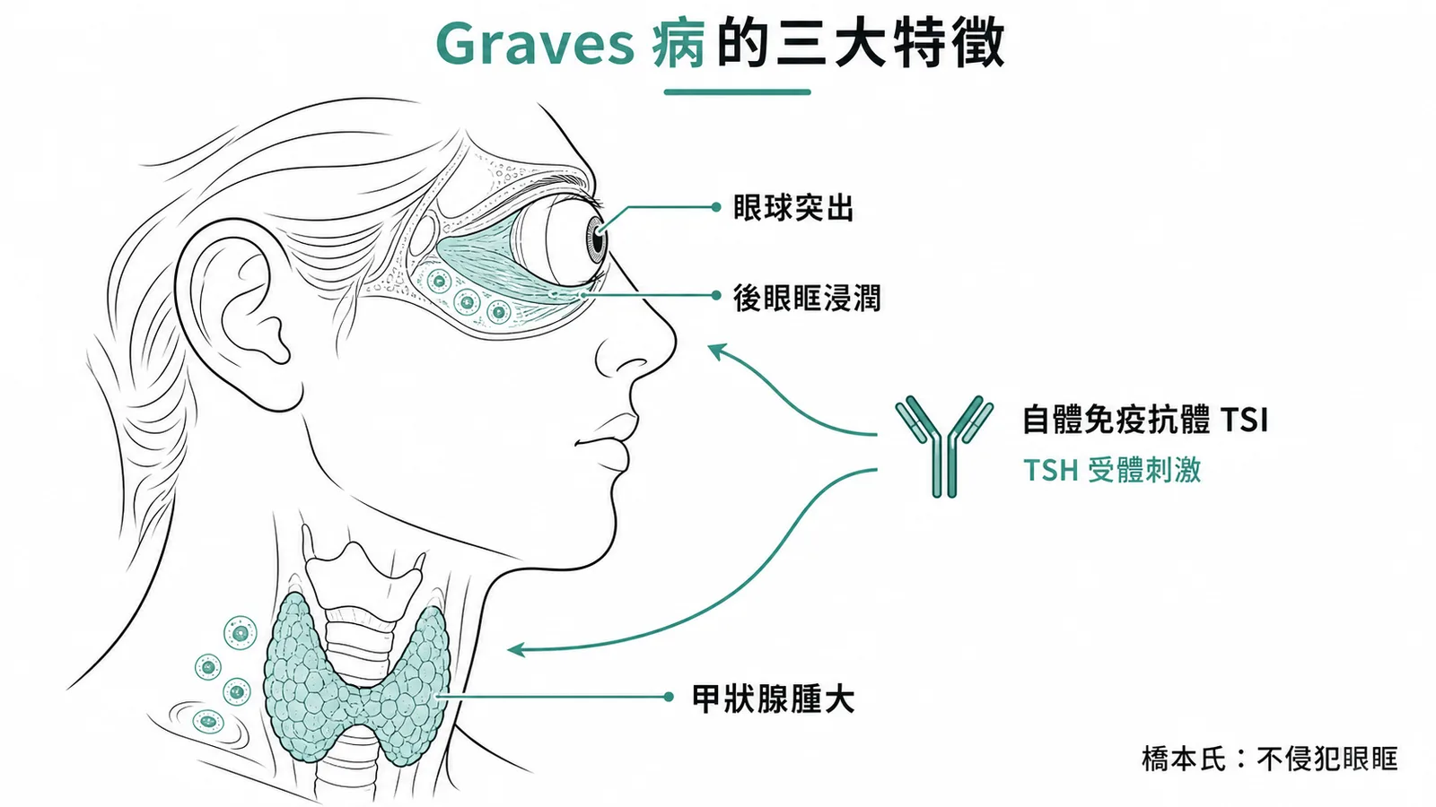 Graves病三大特徵：甲狀腺腫大、眼球突出（後眼眶淋巴球浸潤）、TSI自體免疫抗體，橋本氏不侵犯眼眶