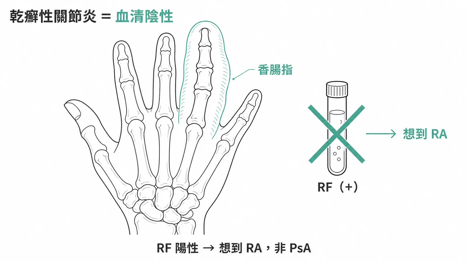 乾癬性關節炎為血清陰性,RF 陽性應想到 RA 而非 PsA