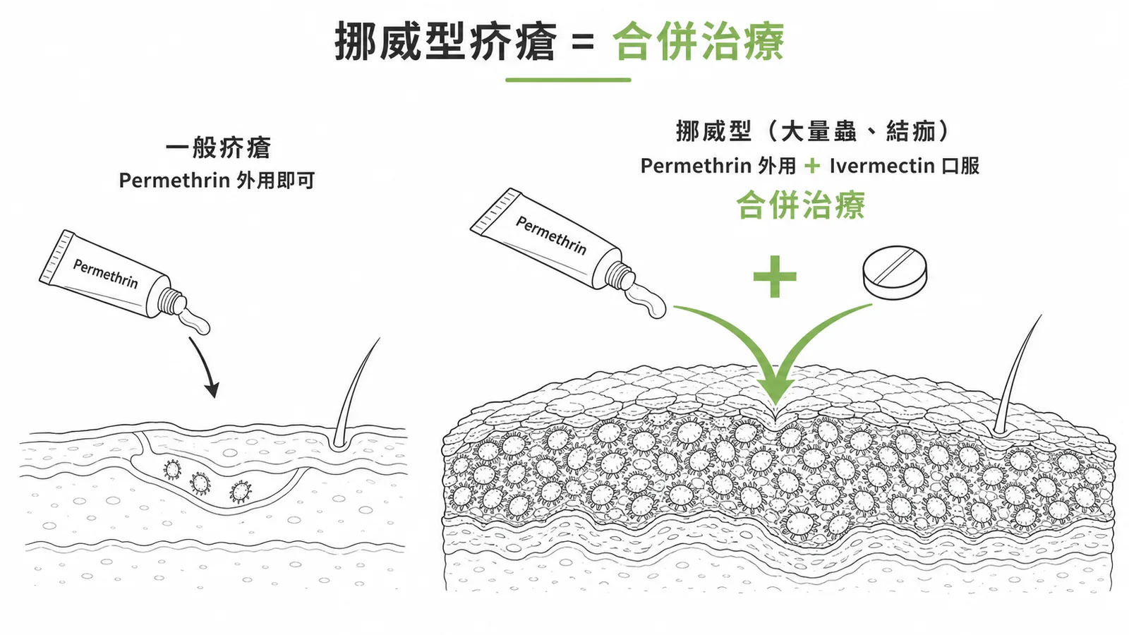 挪威型疥瘡需 Permethrin 外用加 Ivermectin 口服合併治療