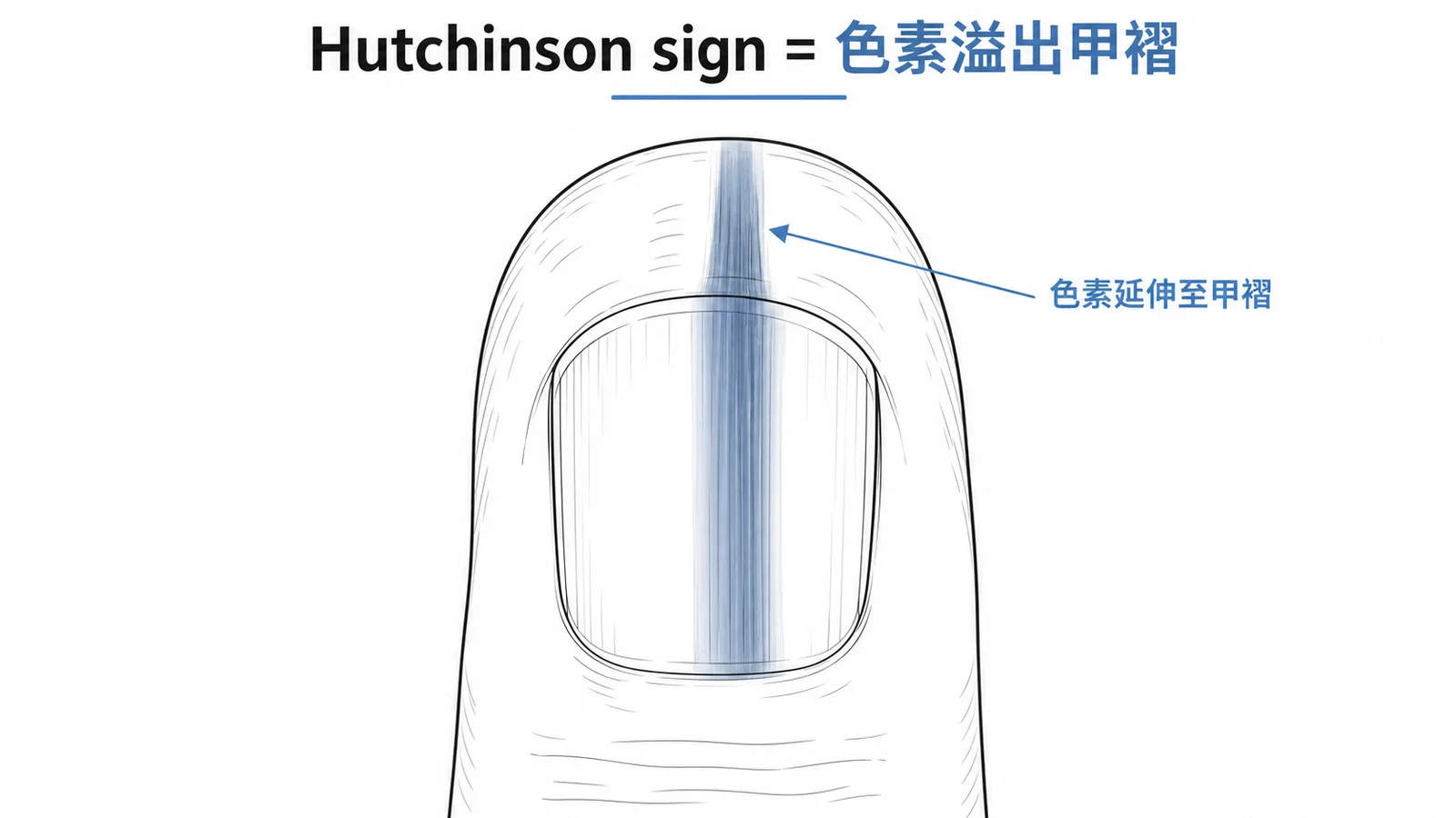 Hutchinson sign 甲下黑色素瘤色素延伸至甲褶皮膚示意圖