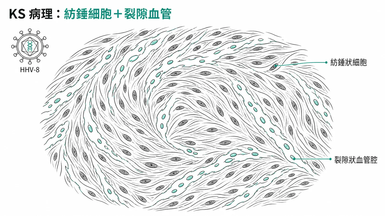 卡波西氏肉瘤病理特徵:紡錘狀細胞與裂隙狀血管腔