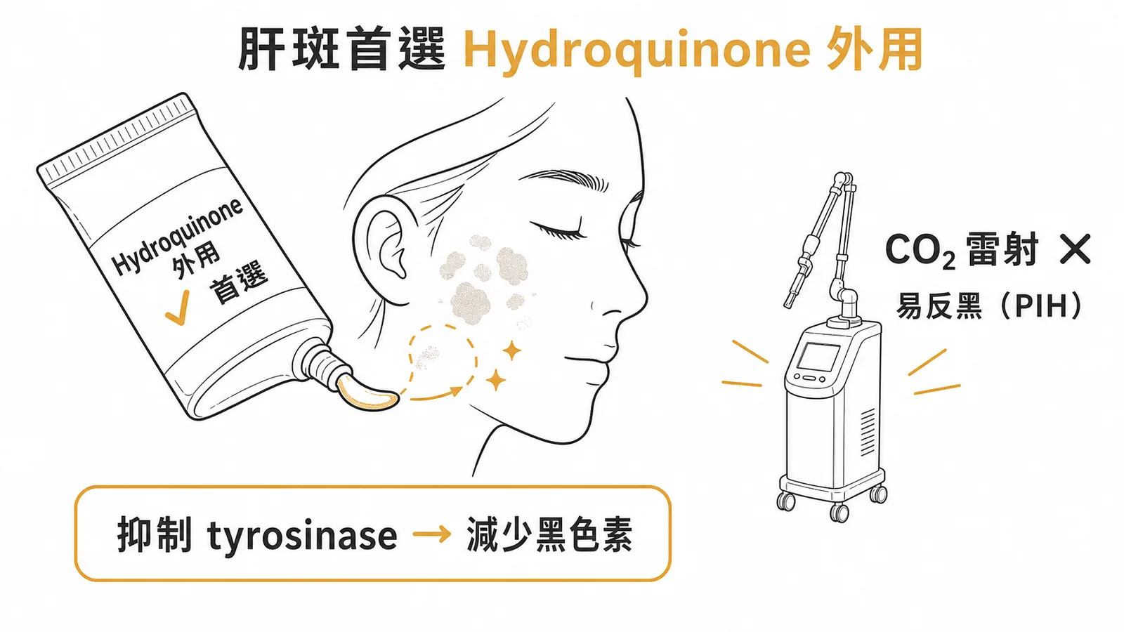 肝斑治療首選 Hydroquinone 外用而非 CO2 雷射
