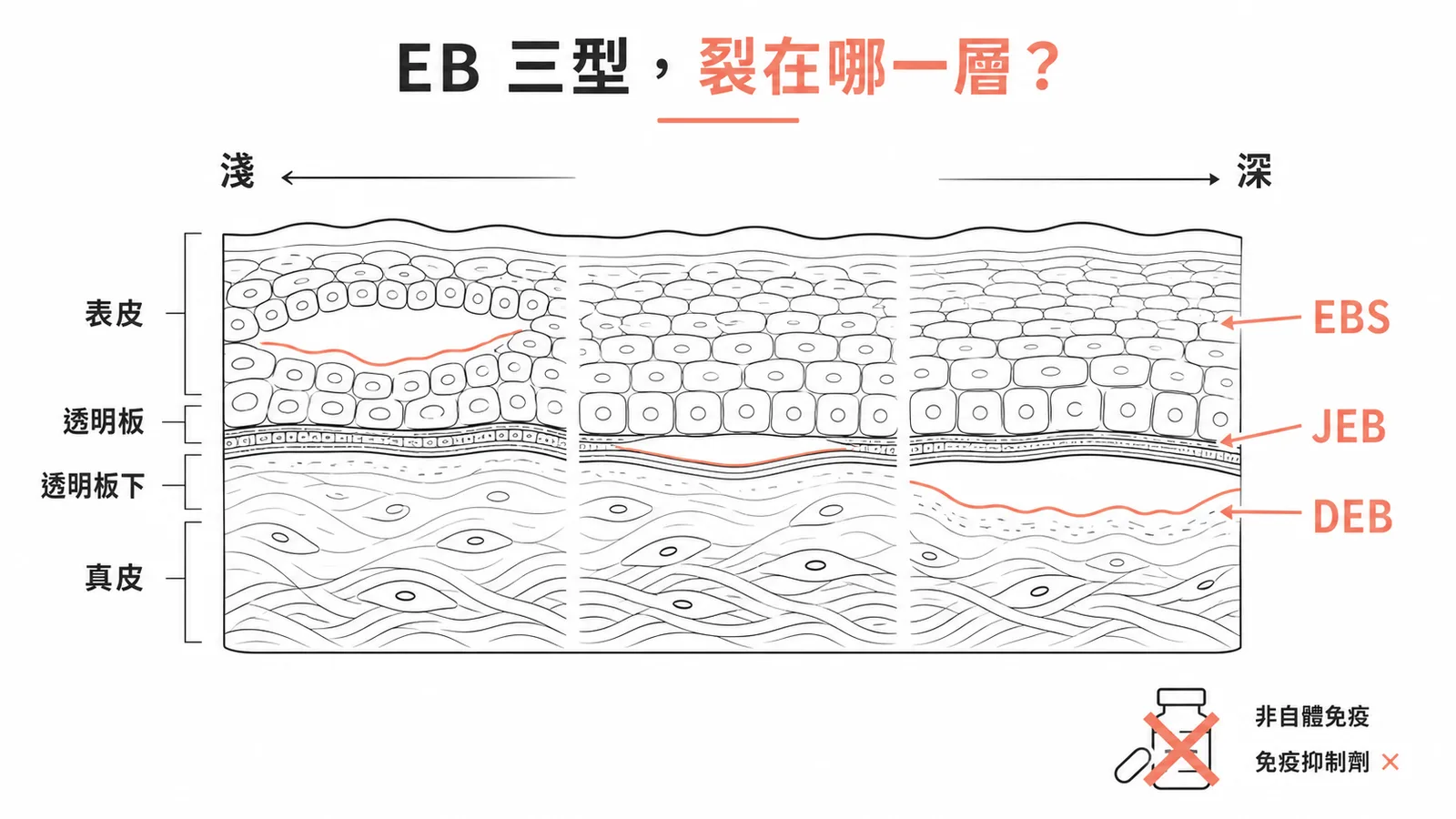 水疱性表皮鬆解症三型裂解層次示意圖：EBS在表皮內、JEB在透明板、DEB在透明板下