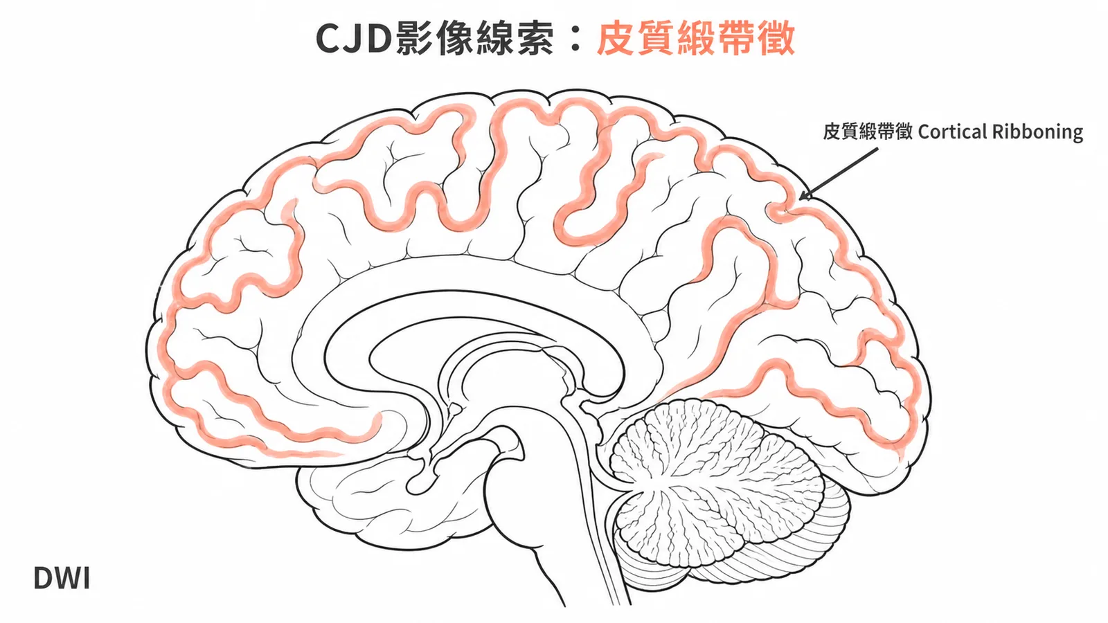 CJD皮質緞帶徵示意圖：DWI序列中大腦皮質沿腦迴出現高亮訊號帶