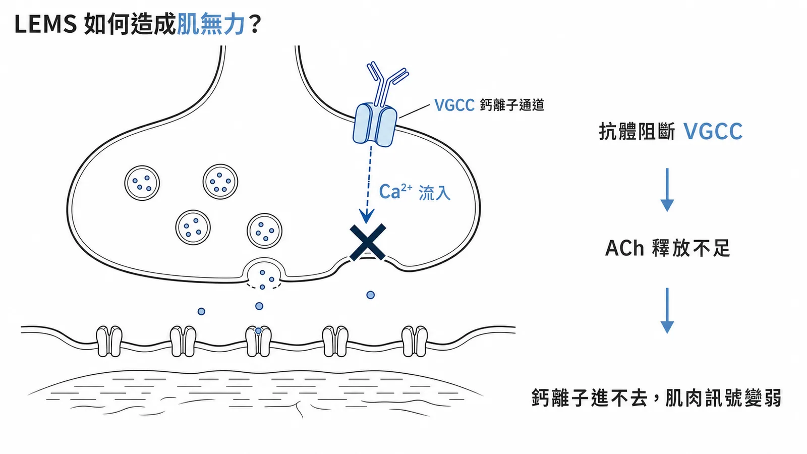 LEMS突觸前鈣離子通道被抗體阻斷導致ACh釋放不足的機轉示意圖