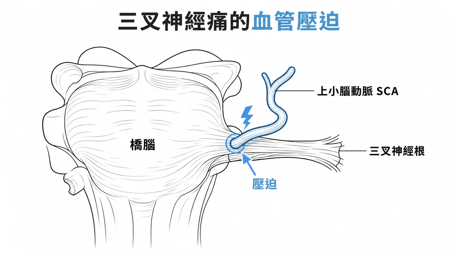 三叉神經根部被上小腦動脈壓迫的解剖示意圖